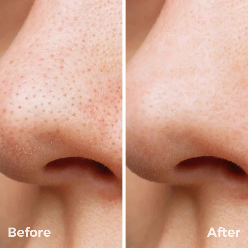 SebumClear Pro Advanced Pore & Sebum Cleansing Device