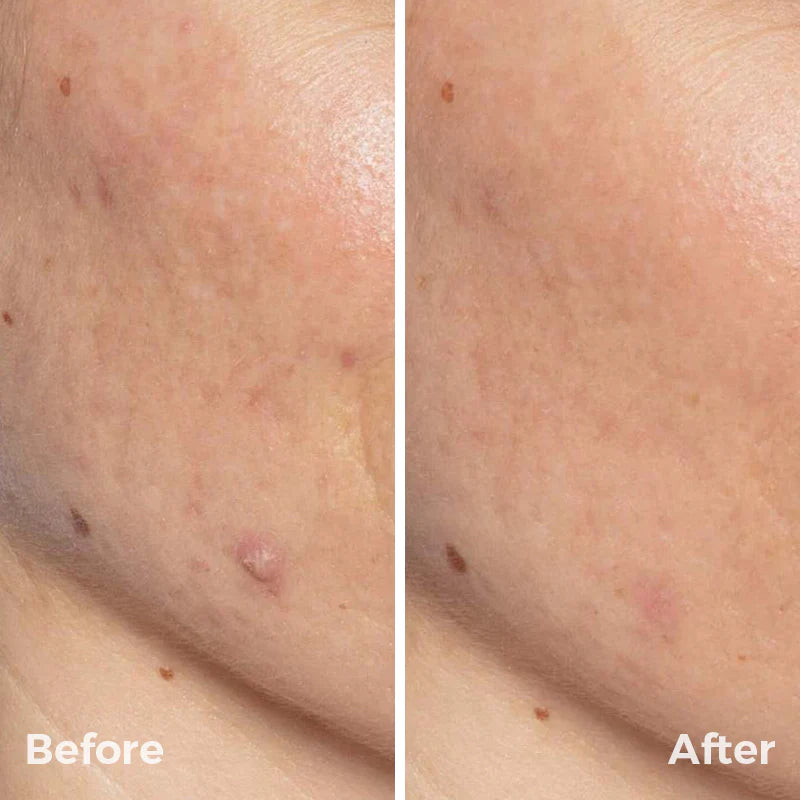 SebumClear Pro Advanced Pore & Sebum Cleansing Device